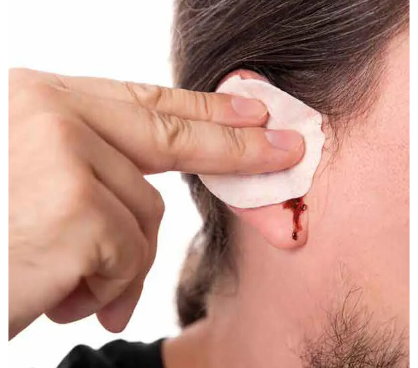 دکتر-پارگی-پرده-گوش