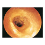 اوتیت گوش خارجی چیست؟