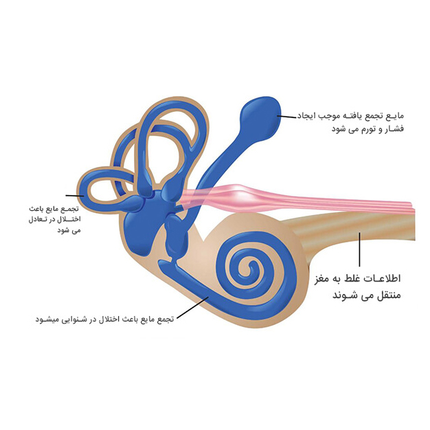 روش‌های-نوین-درمان-بیماری-سندرم-مینیر