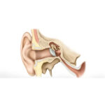 مقایسه درمان‌های مختلف برای سندرم مینیر